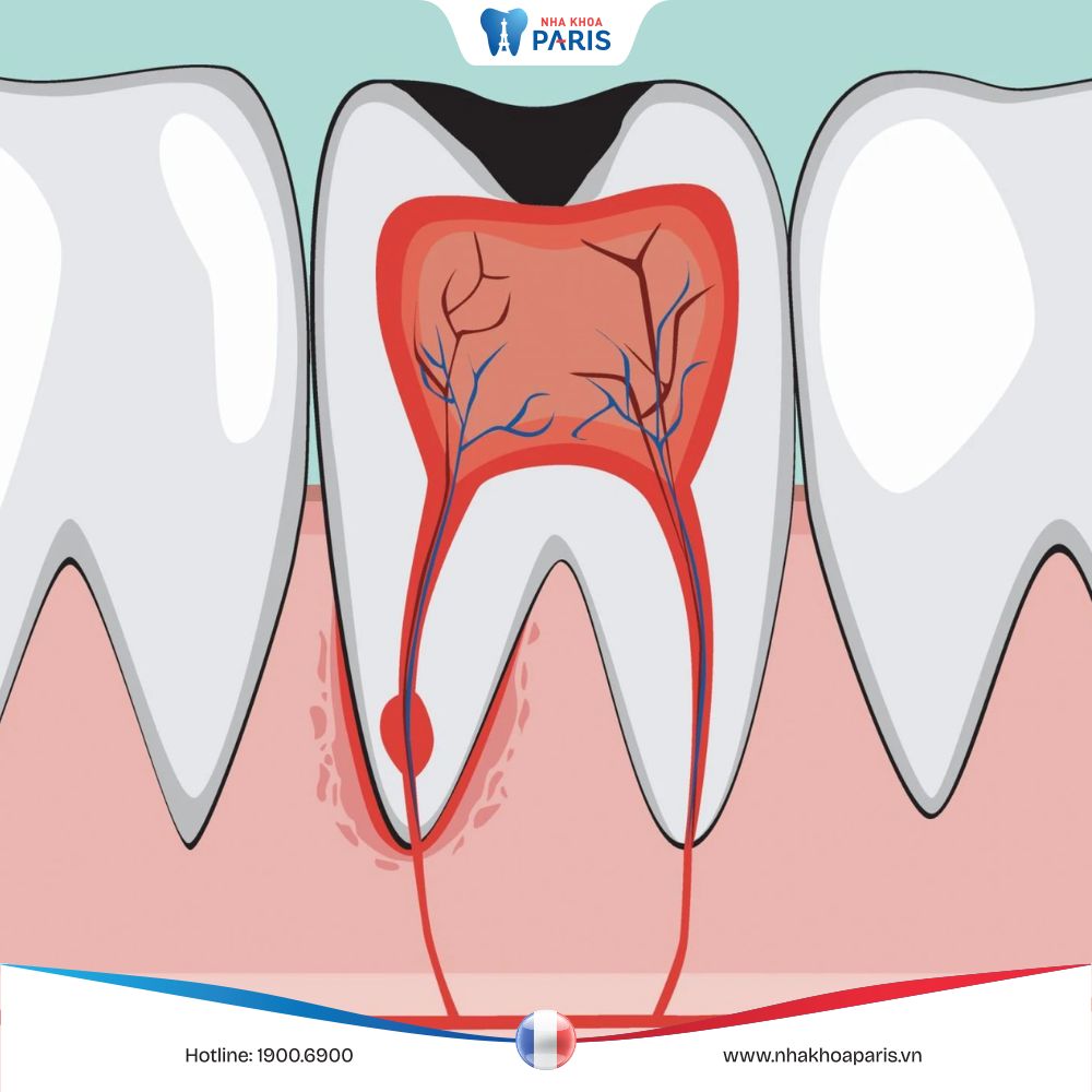 Viêm tủy răng có tự khỏi không? Giải đáp từ chuyên gia nha khoa