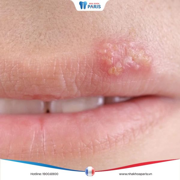 Bệnh sùi mào gà ở miệng: Nguyên nhân, dấu hiệu và cách điều trị