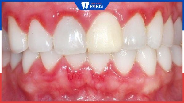 Bệnh viêm nướu răng: Nguyên nhân, triệu chứng và cách điều trị