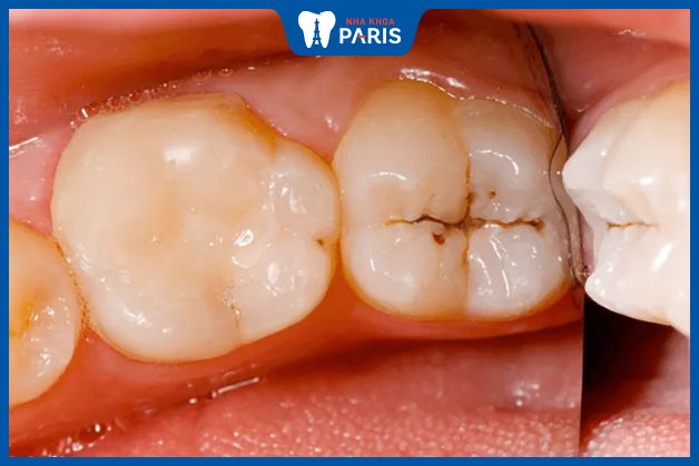 Bệnh sâu răng cần được điều trị triệt để trước khi bọc sứ