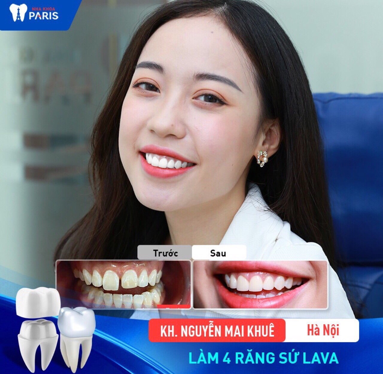 Diện mạo hàm răng thay đổi sau khi bọc sứ