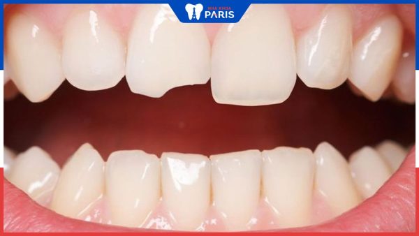 Nguyên nhân làm răng cửa bị mẻ? Quy trình bọc sứ răng cửa bị mẻ hoàn chỉnh
