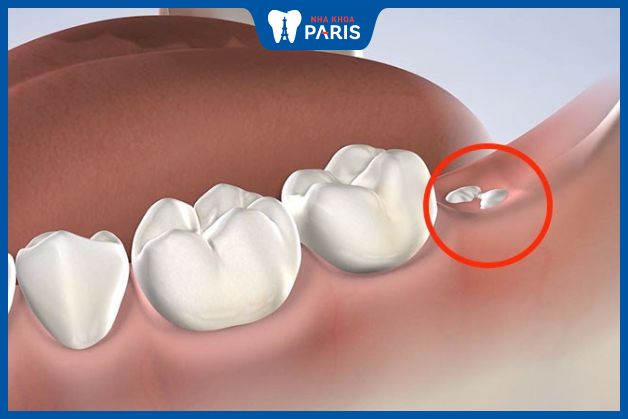 Mọc răng khôn gây đau nhức do cấu trúc nướu bị phá vỡ