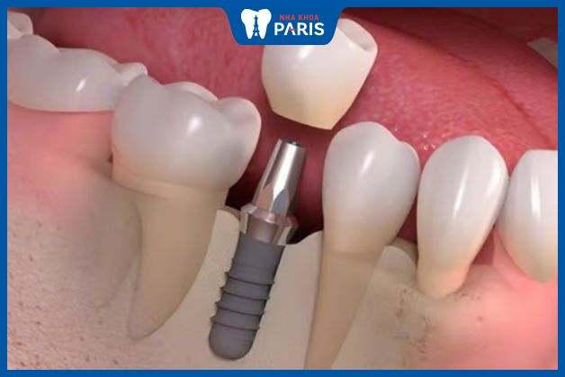 Tìm hiểu về cắm trụ răng Implant