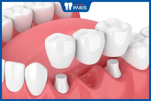 Cầu răng sứ là phương pháp phục hình răng bị mất