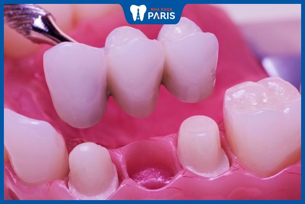 Trồng răng bắc cầu là phương pháp phục hình răng an toàn