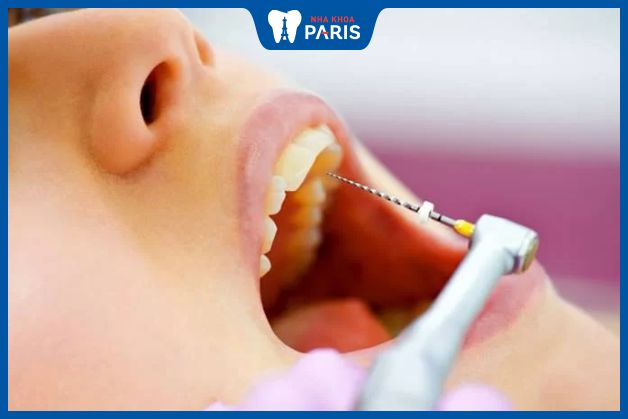Chữa tủy răng an toàn tại nha khoa