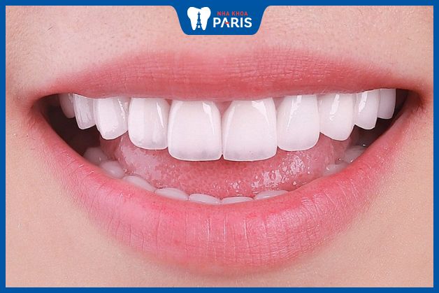 Răng trắng sáng khi lấy vôi răng định kỳ