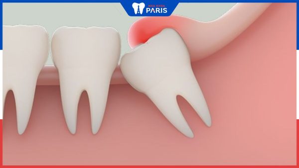 7 Dấu hiệu nhận biết răng khôn mọc lệch hàm phổ biến nhất