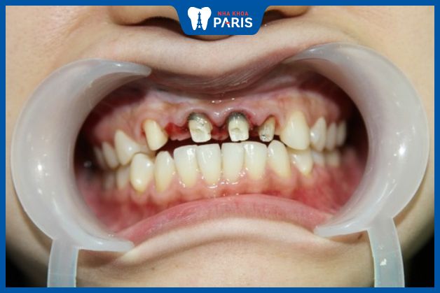 Chết tủy răng là hậu quả bọc răng sứ sai cách