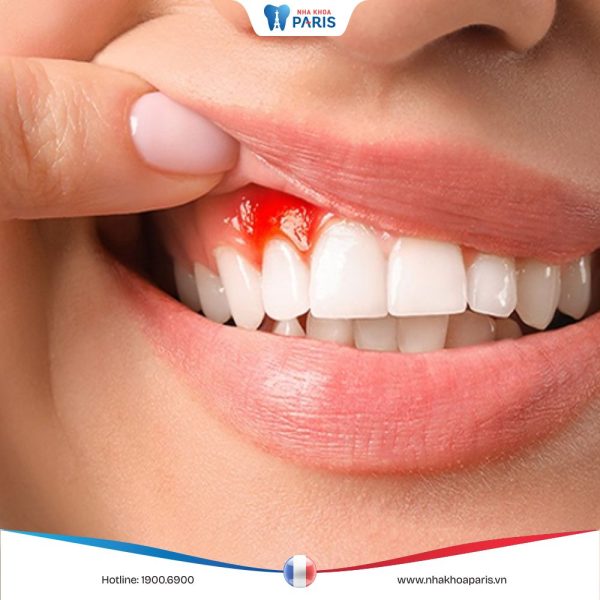 Hay chảy máu chân răng: Nguyên nhân và biện pháp điều trị