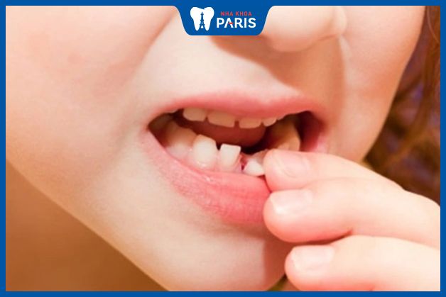 Nhổ răng sữa khi đến giai đoạn thay răng