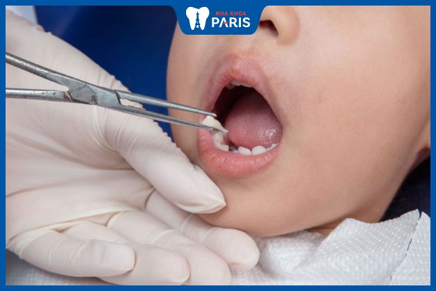 Trẻ nhổ răng sữa ra khỏi cung hàm
