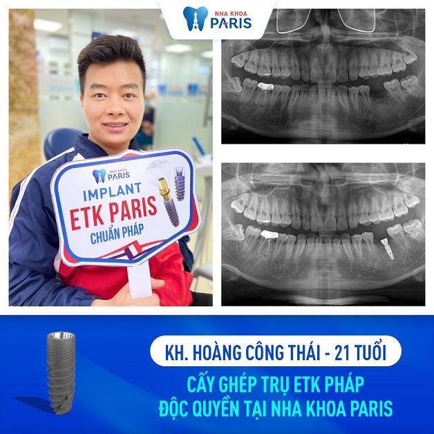 Khách hàng trồng Implant răng cấm tại Nha khoa Paris