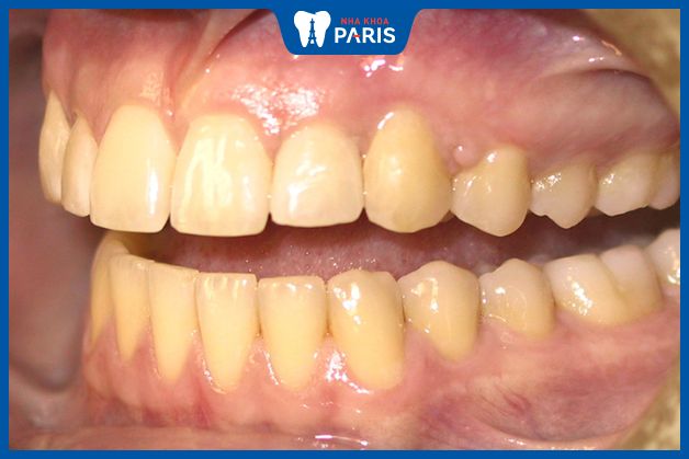 Hiệu quả tẩy trắng phụ thuộc vào mức độ ố vàng của răng