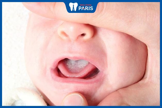 Mảng trắng trong miệng của trẻ do nhiễm nấm Candida
