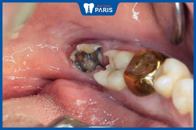 Nhổ răng hàm trong trường hợp răng bị sâu ở mức độ nặng