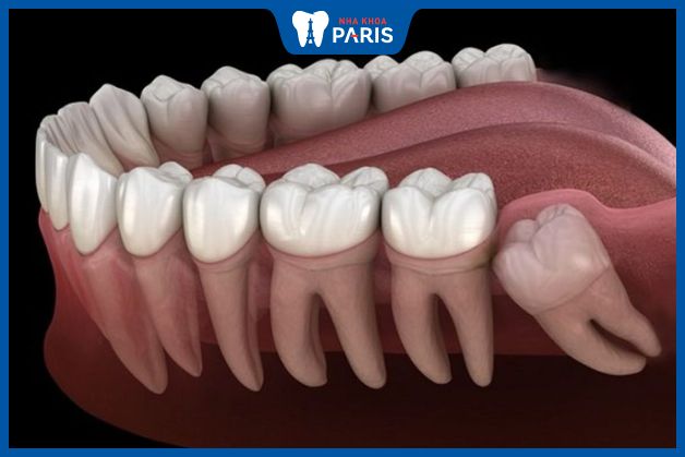 Nhổ bỏ răng mọc ngầm sớm giúp ngăn chặn được nhiều biến chứng nguy hiểm