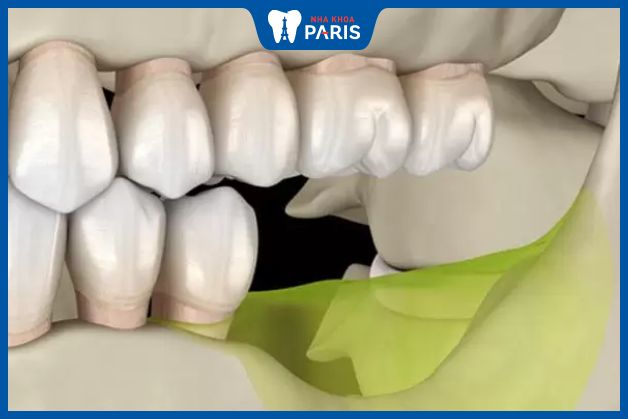 Mật độ xương hàm bị tiêu biến sau một thời gian nhổ bỏ răng hàm số 7