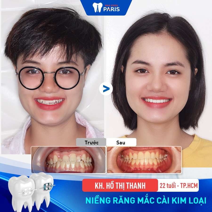 Niềng răng giúp khắc phục hoàn toàn các khuyết điểm của hàm răng