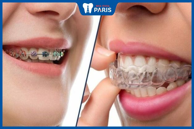 Nha Khoa Paris có đa dạng dịch vụ chỉnh nha - niềng răng ở đâu tốt nhất tphcm