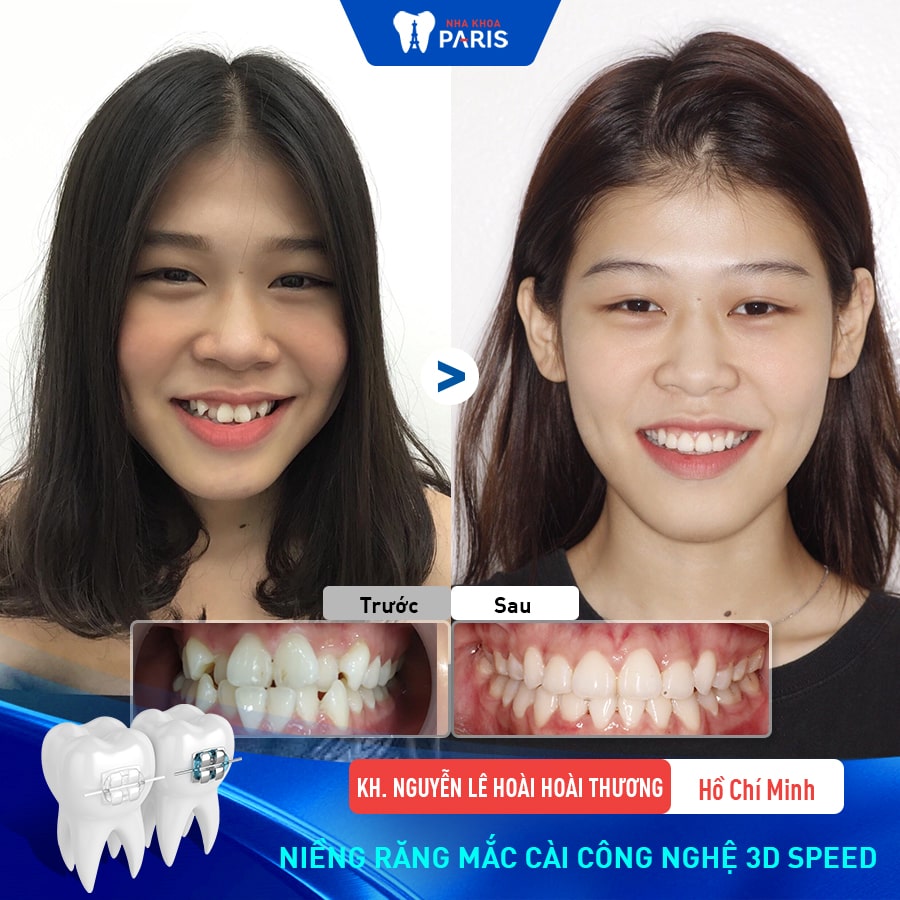 Niềng răng khắc phục tình trạng răng khấp khểnh