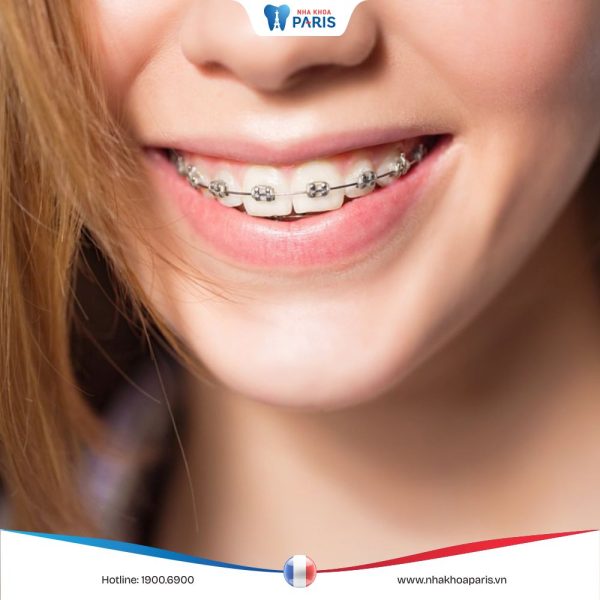 Niềng răng ở đâu tốt nhất TPHCM, review chi tiết từ khách hàng
