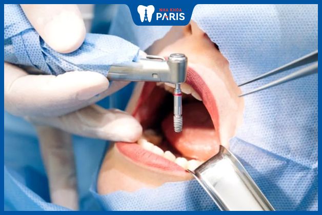Quy trình cắm trụ răng Implant