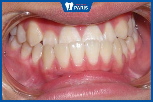 Niềng răng móm kéo dài từ 12 -24 tháng
