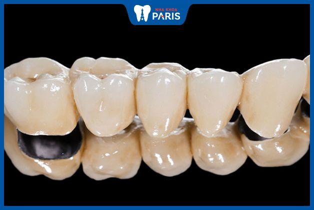 Răng sứ Titan có khả năng tương thích cao nên giá nhỉnh hơn răng kim loại thông thường