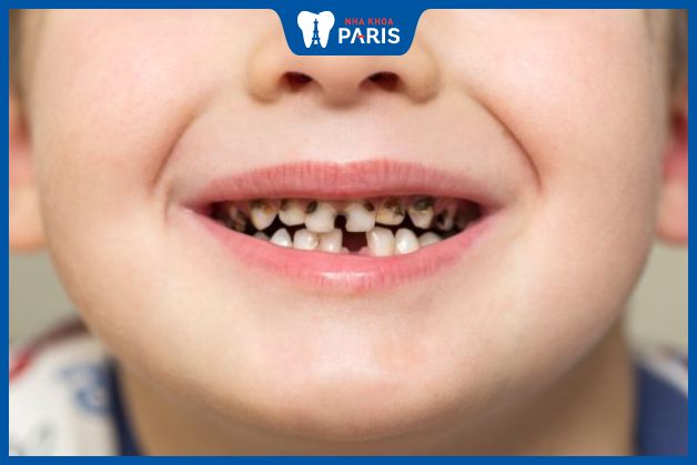 Bề mặt men răng của trẻ có đốm đen do vi khuẩn sâu răng
