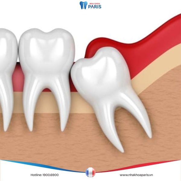 Tình trạng sưng lợi răng khôn: Nguyên nhân và giải pháp điều trị