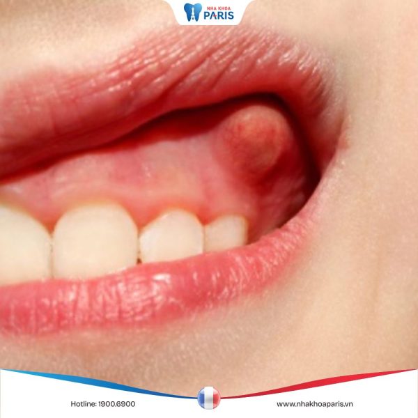 Sưng nướu răng có mủ: Triệu chứng, nguyên nhân và cách điều trị