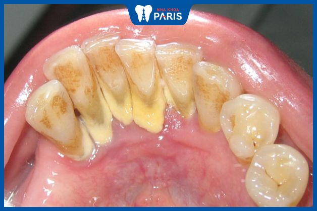Cao răng ảnh hưởng đến sức khỏe răng miệng
