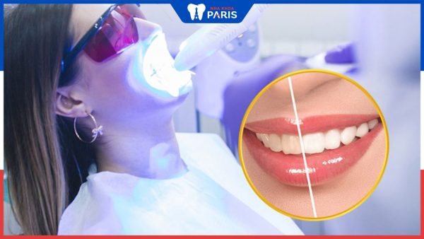 Tẩy trắng răng WhiteMax – Khắc phục răng xỉn màu vượt trội