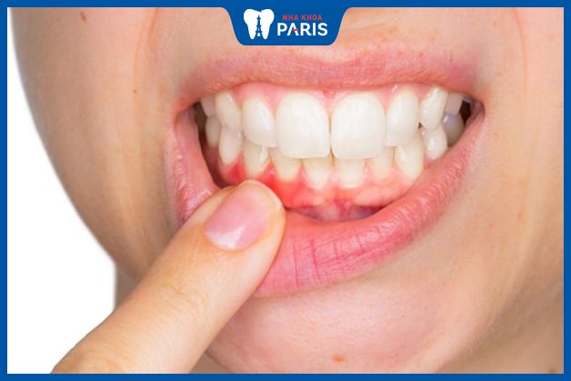 Tìm hiểu về bệnh viêm nướu răng