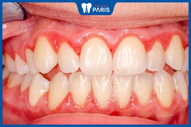 Tìm hiểu về viêm nướu răng