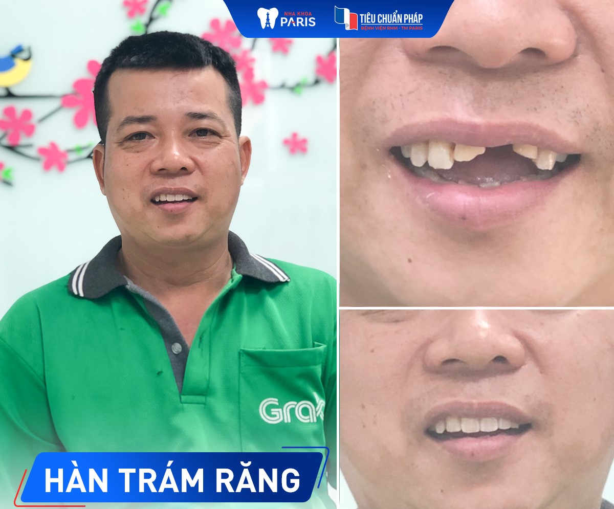Hàm răng trước và sau khi trám