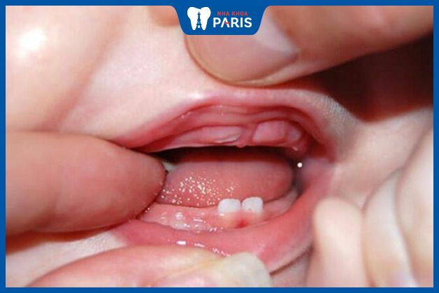 Trẻ thường mọc răng từ 6 tháng tuổi