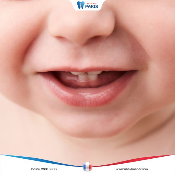 Trình tự mọc răng của bé và những lưu ý cho cha mẹ khi chăm sóc