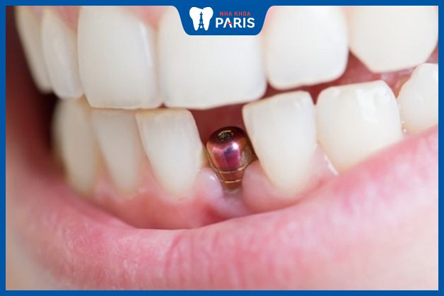 Trồng răng Implant là phương pháp phục hình an toàn
