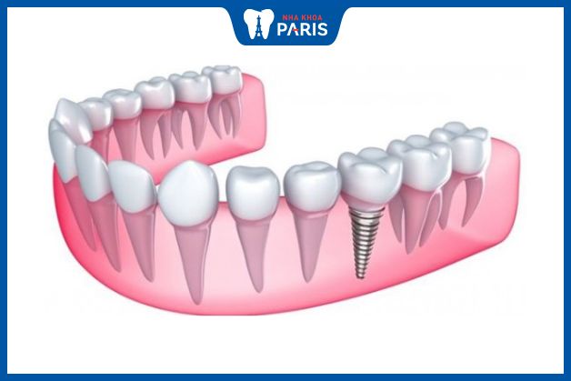 Cấy ghép răng Implant là phương pháp an toàn