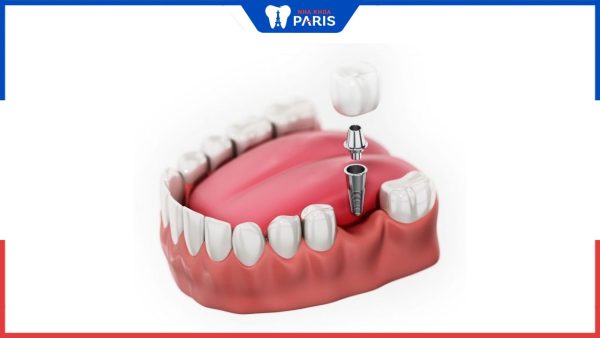 Trồng răng cấm Implant giá bao nhiêu, các yếu tố ảnh hưởng đến giá