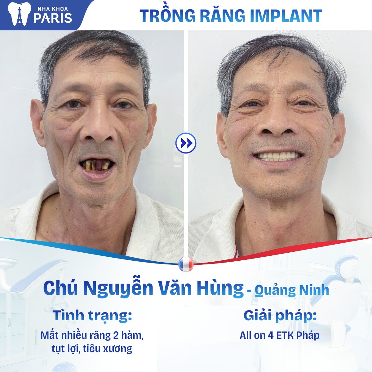 Cấy ghép Implant là phương pháp phục hình răng mất nhiều thời gian nhất