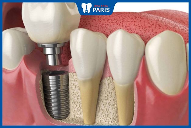 Yếu tố ảnh hưởng tới mức độ đau khi trồng răng Implant