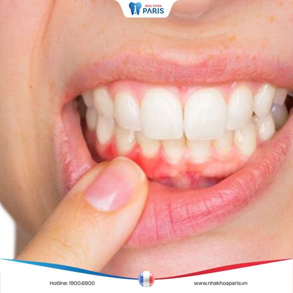 Viêm nướu chân răng: Nguyên nhân, triệu chứng và cách điều trị