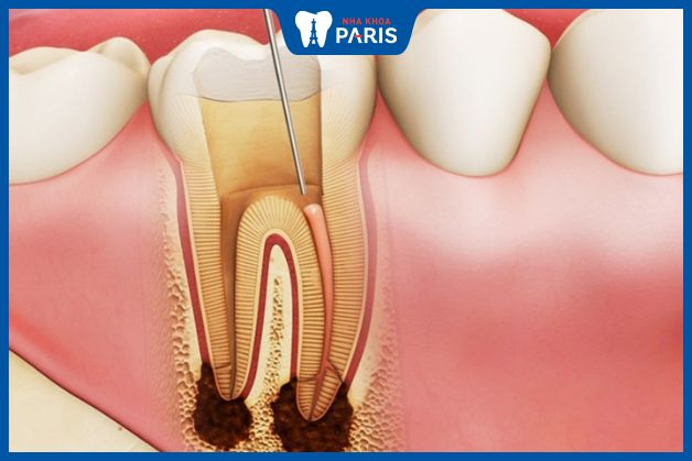 Viêm tủy răng là một bệnh lý khá phổ biến