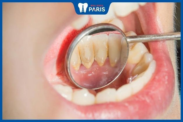 Điều trị tụt lợi nhẹ bằng việc lấy cao răng và dùng thuốc