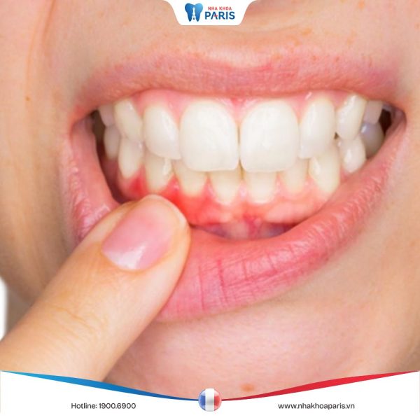 Tổng hợp các cách trị sưng nướu răng nhanh chóng và hiệu quả