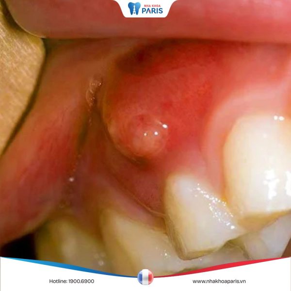 Cục mủ nhỏ dưới nướu chân răng là dấu hiệu của bệnh gì
